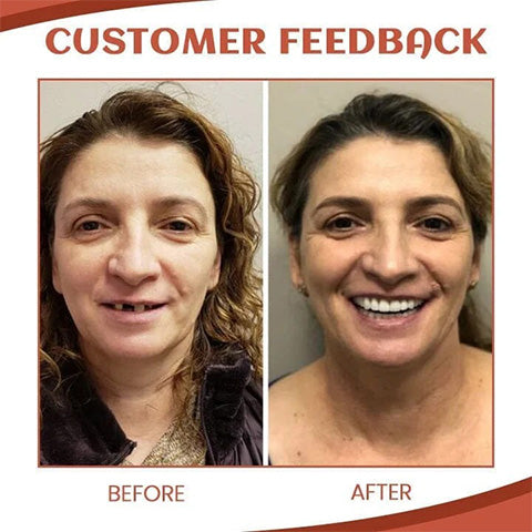 🎁 Custom Fit Denture Kit – Easy DIY Solution